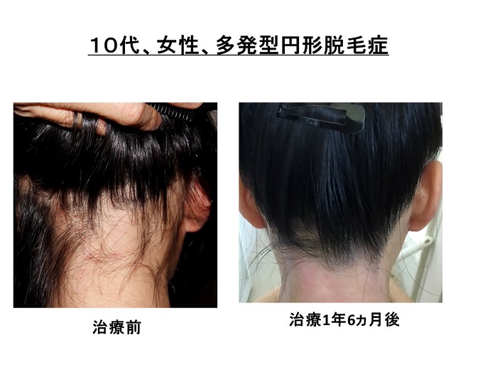 円形脱毛症　病院